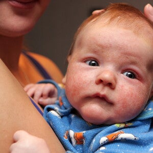 [Guideline Summary] The American Academy of Pediatrics Guidelines on Allergy Prevention in Infants and Children