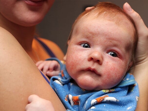 baby-and-eczema